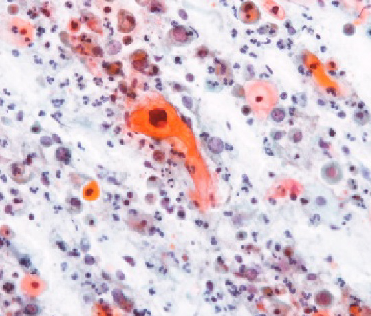 細胞診標本の顕微鏡像（扁平上皮癌）の写真です。
